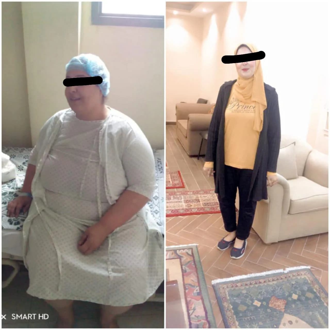 سنه بعد تكميم المعده