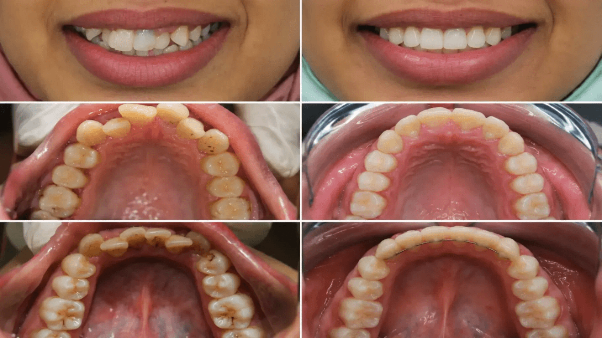 قبل وبعد تقويم الأسنان لعلاج تزاحم الأسنان وتحسين الابتسامة