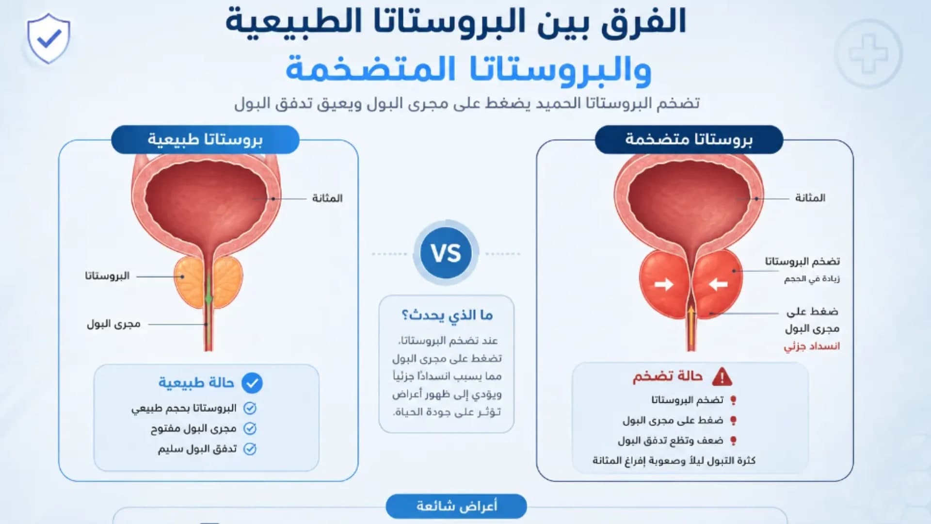 الفرق بين البروستاتا الطبيعية والبروستاتا المتضخمة مع شرح أعراض تضخم البروستاتا وتأثيرها على التبول.