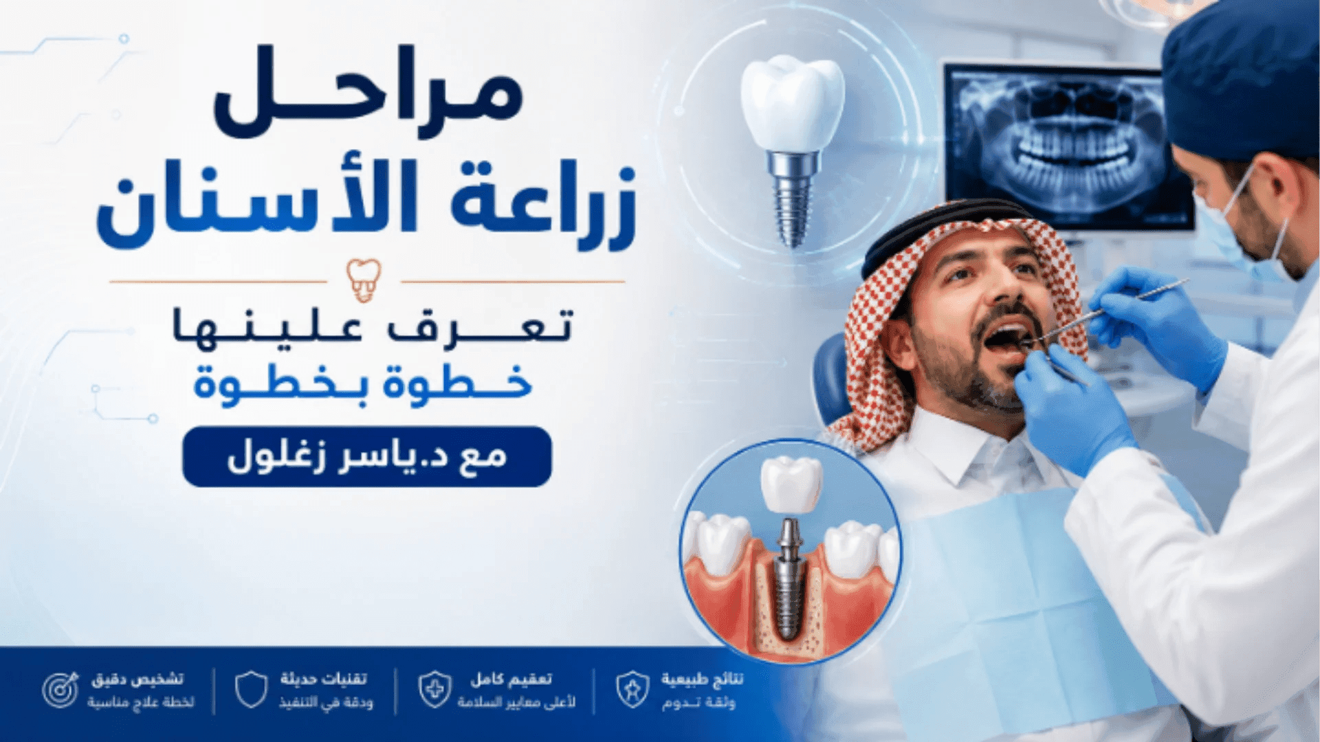 ما هي مراحل زراعة الأسنان بالتفصيل ؟ تعرف عليها خطوة بخطوة مع د. ياسر زغلول